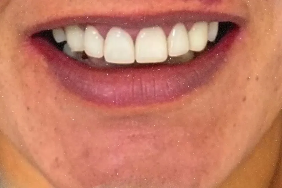 Sorriso após facetas de resina feitas na Sorria Paranavaí