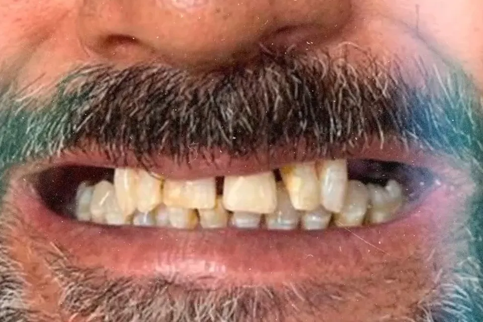 Antes: dentes desalinhados, com falhas e desgaste