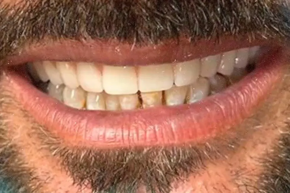 Sorriso real de paciente após reabilitação com implantes na Sorria Paranavaí