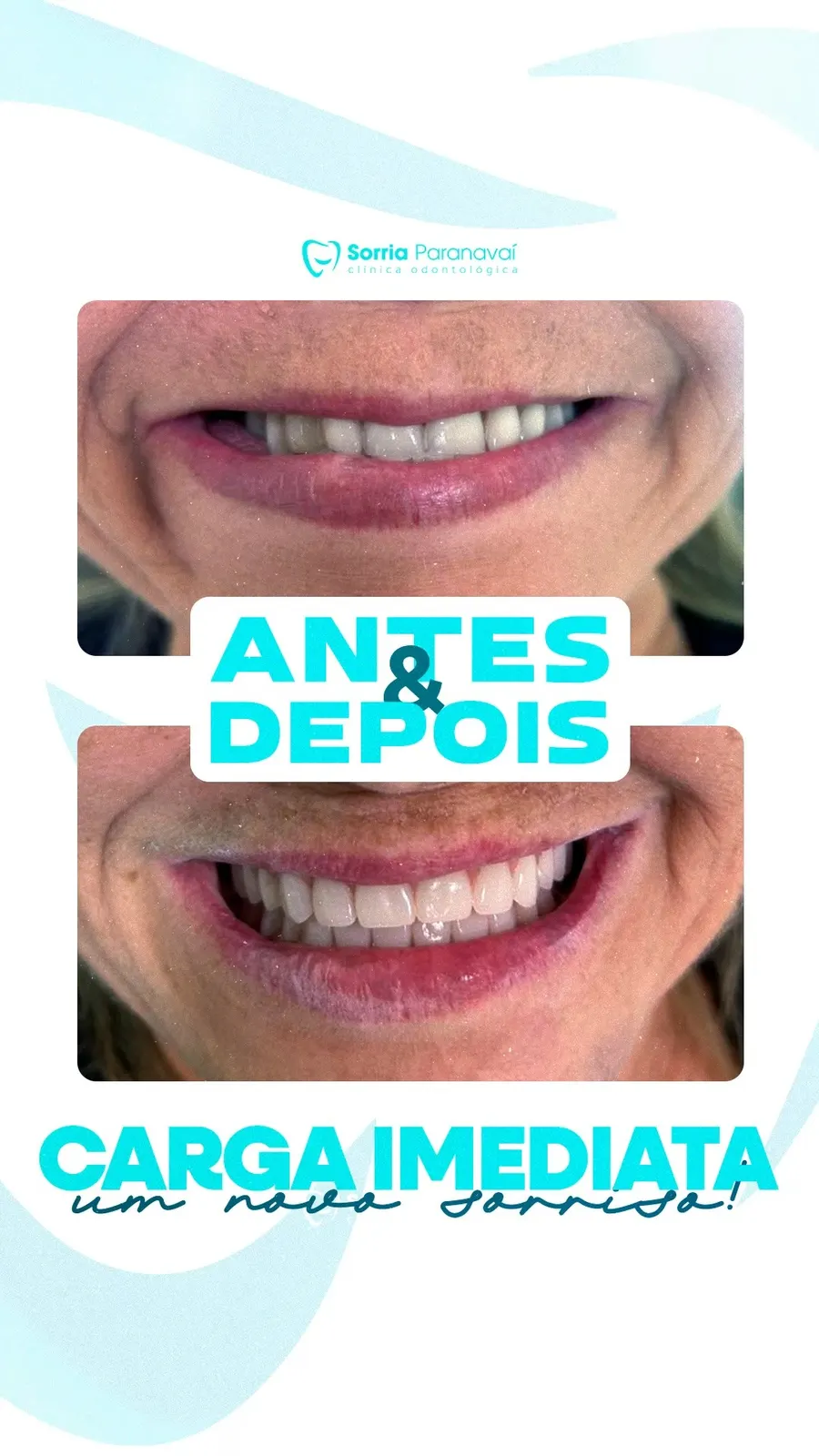 Antes e depois de implante com carga imediata