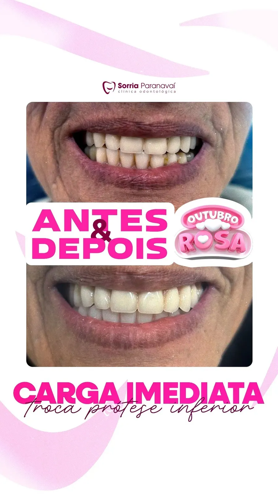 Antes e depois de carga imediata com troca de prótese inferior