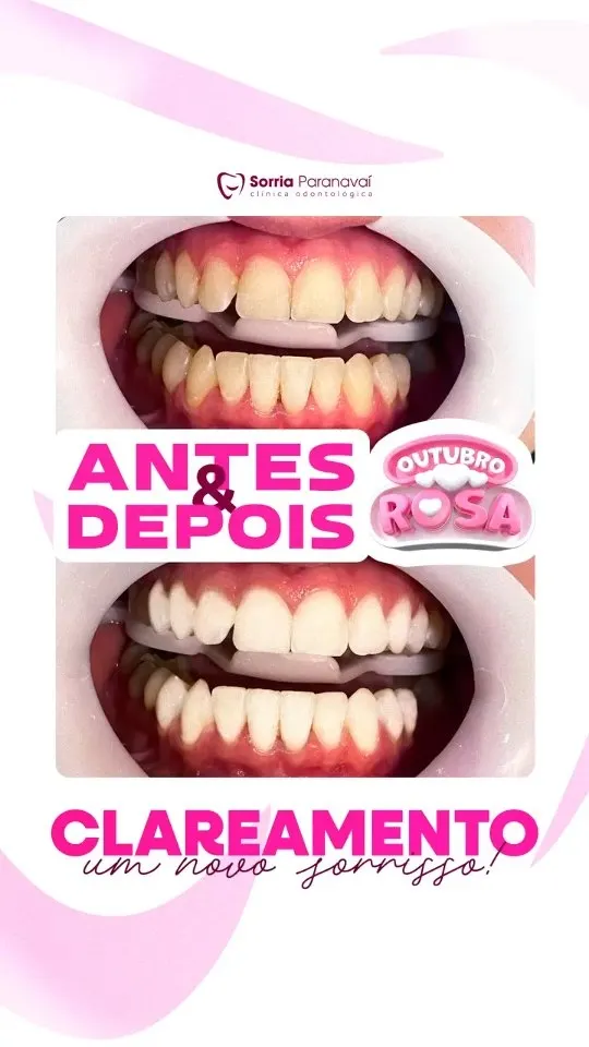 Antes e depois de clareamento dental, edição Outubro Rosa