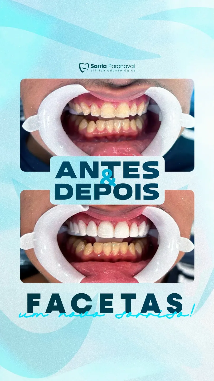 Antes e depois de facetas dentárias com afastador labial