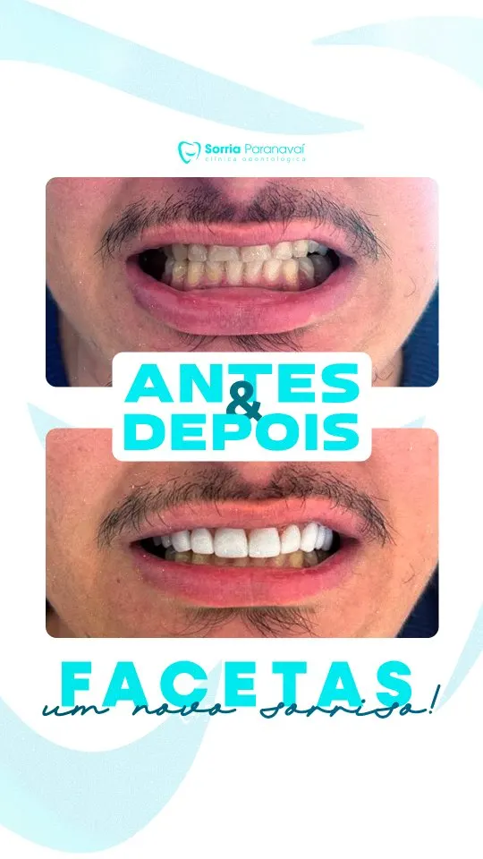 Antes e depois de facetas de resina