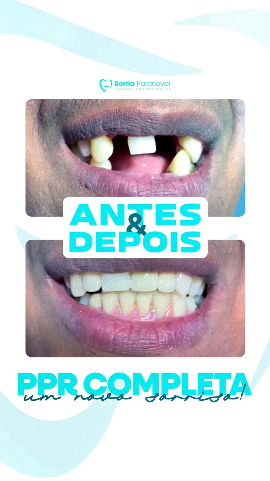 Antes e depois de prótese parcial removível completa