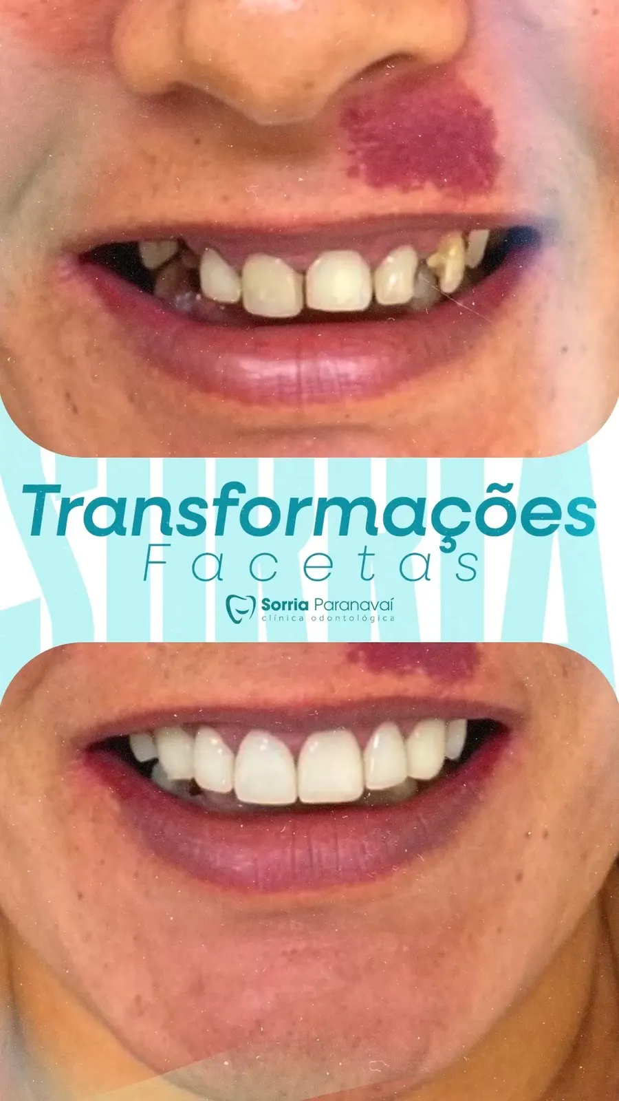 Antes e depois de facetas: dentes escurecidos e desgastados transformados em sorriso claro e harmônico