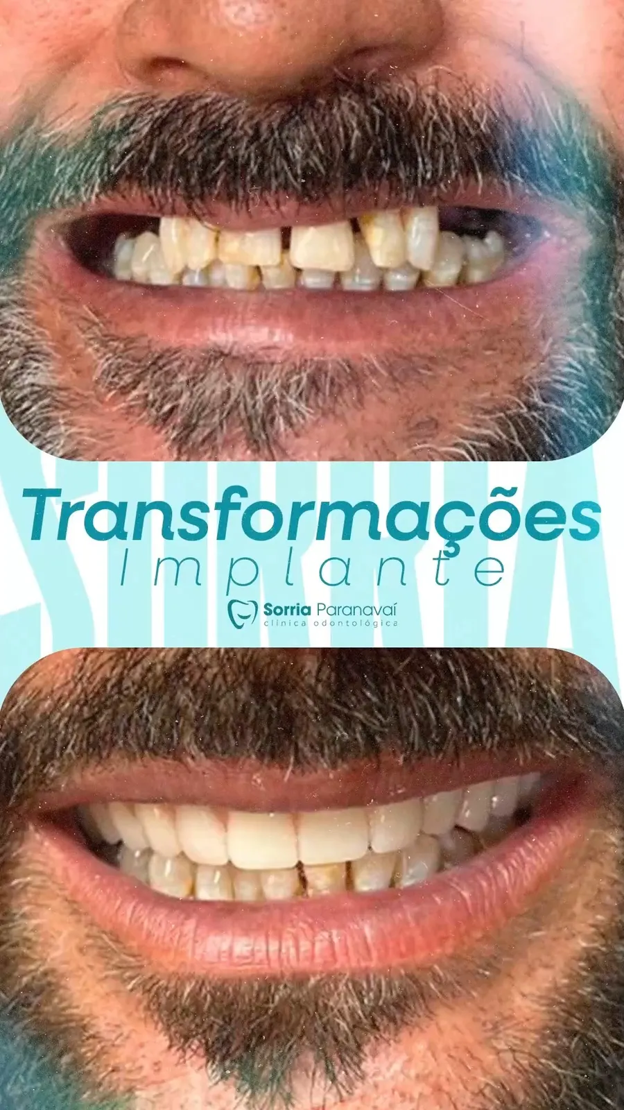 Transformação com implante: dentes desalinhados antes e sorriso reabilitado depois