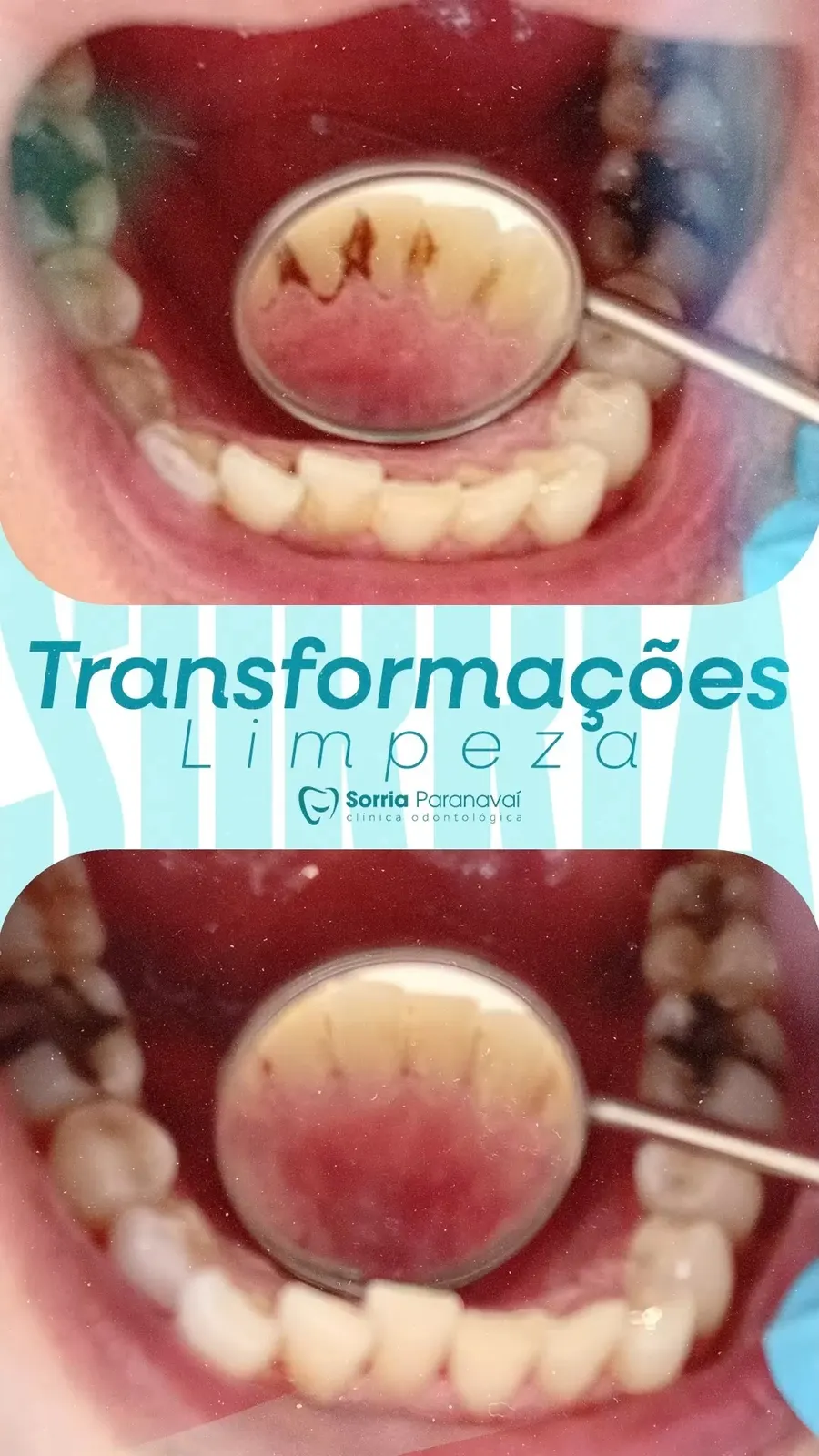 Antes e depois de limpeza profissional com remoção de tártaro